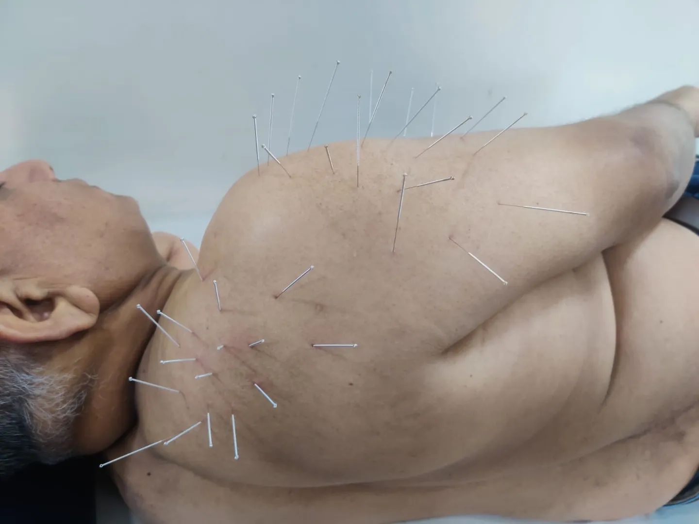 best shoulder pain treatment in Pune
best nonsur...