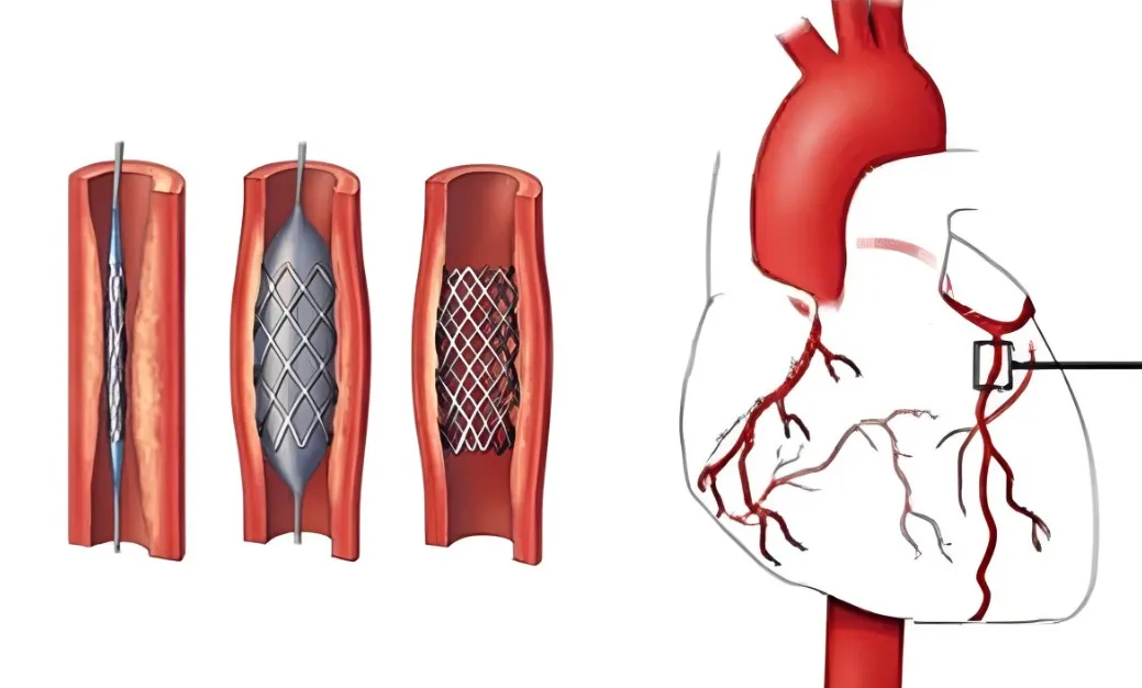 Completion Angiography in Nagpur: Key to Monitorin...