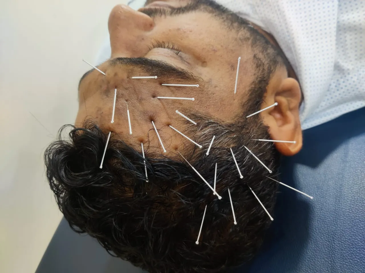 Post-herpetic neuralgia (PHN) is a painful conditi...