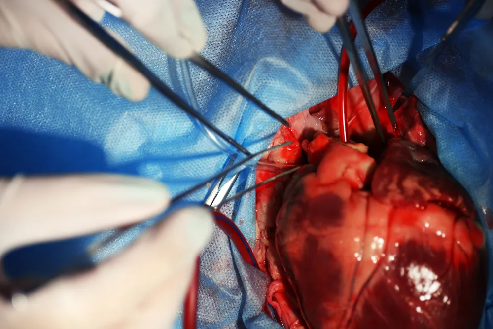 Remove Heart Blocks Without Bypass Surgery: Modern...
