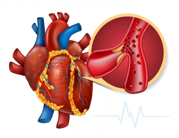 Coronary Artery Disease Treatment in Chennai: Comp...