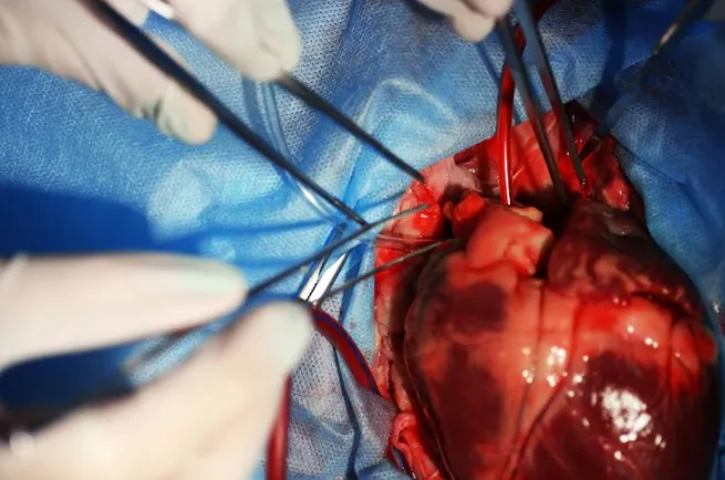 Beating Heart Bypass Surgery in Nagpur: A Minimall...