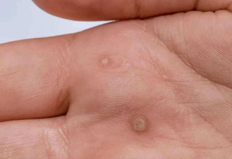 Warts Treatment in Thane Warts can be stubborn and...