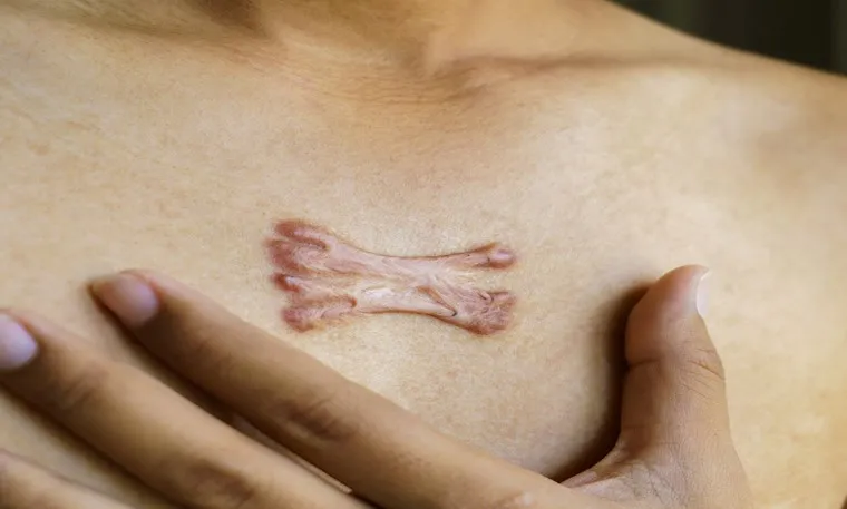Effective Keloid Treatment in Thane Keloids can be...