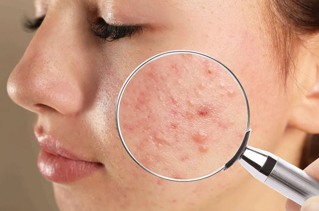 Best Pimple Treatment in Thane Pimples can affect ...