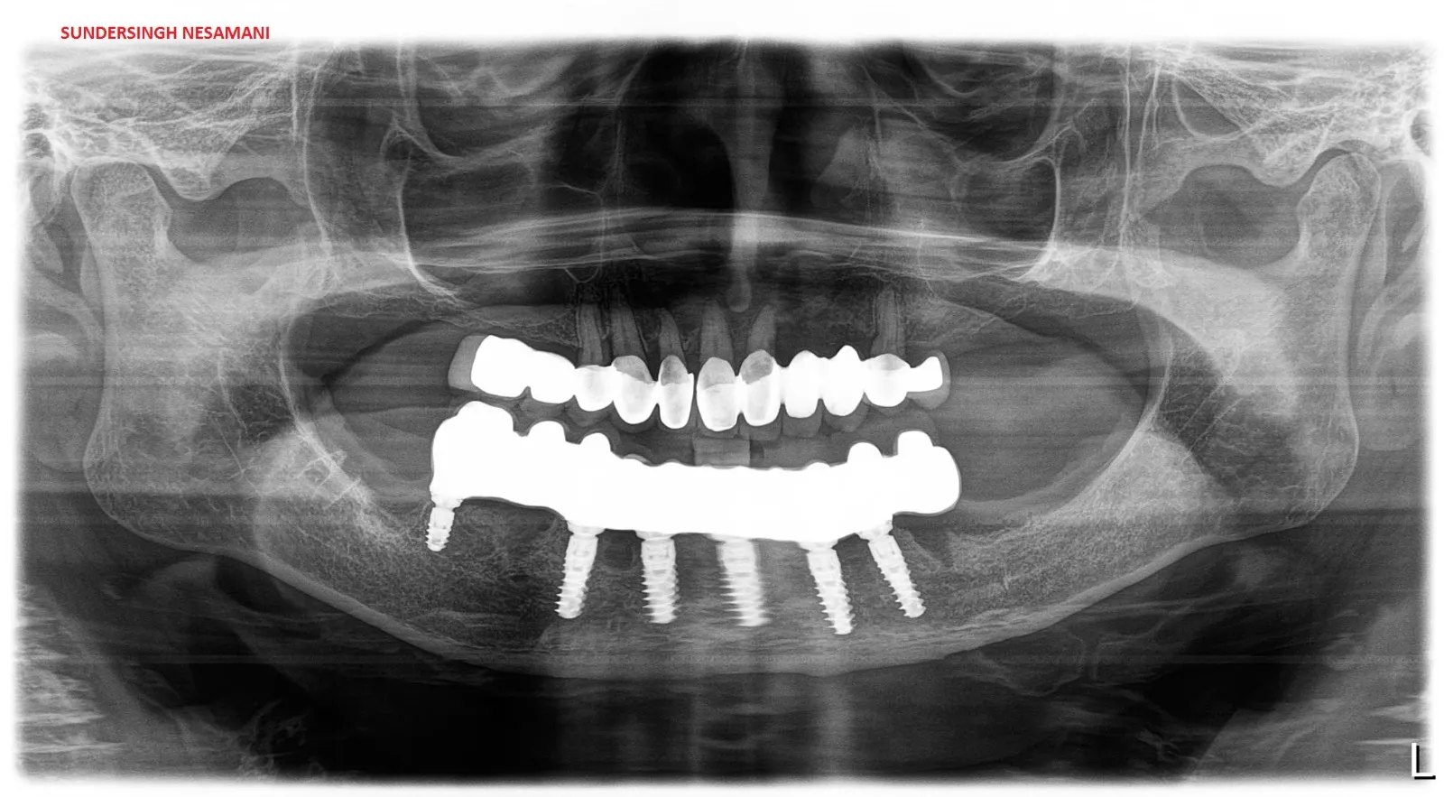 Immediately loaded straumann BLX implants with rig...