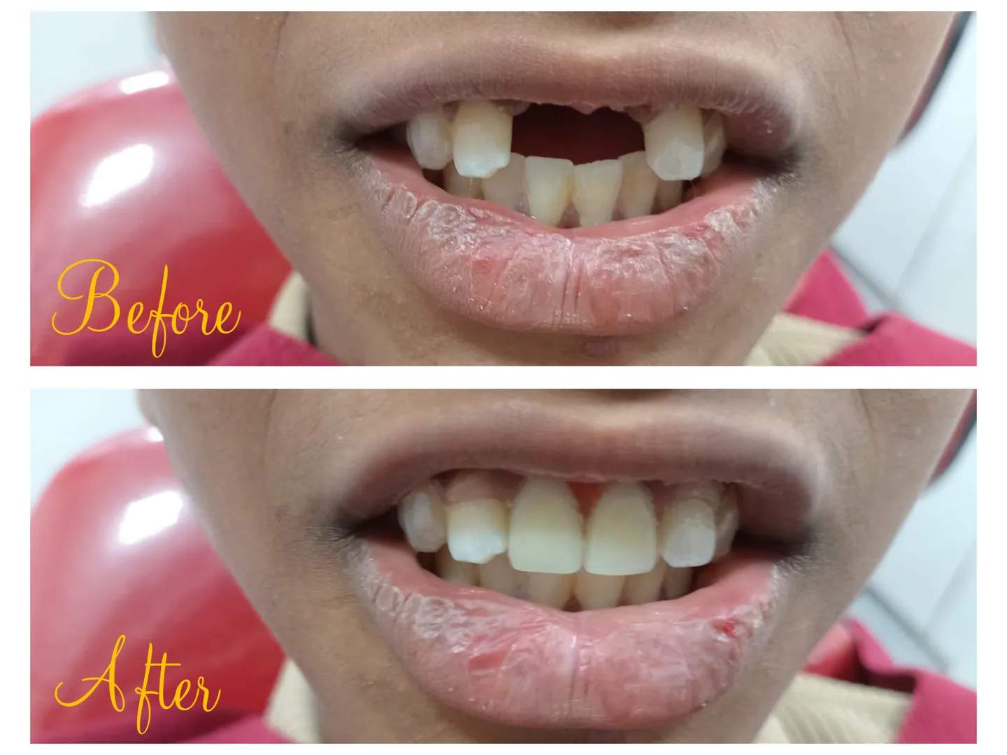 The young boy lost front teeth due to trauma and w...