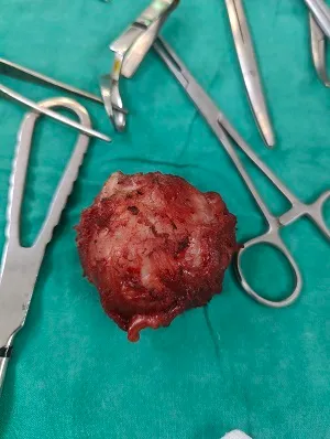 A Rare Success Story: Excision of Intramuscular De...
