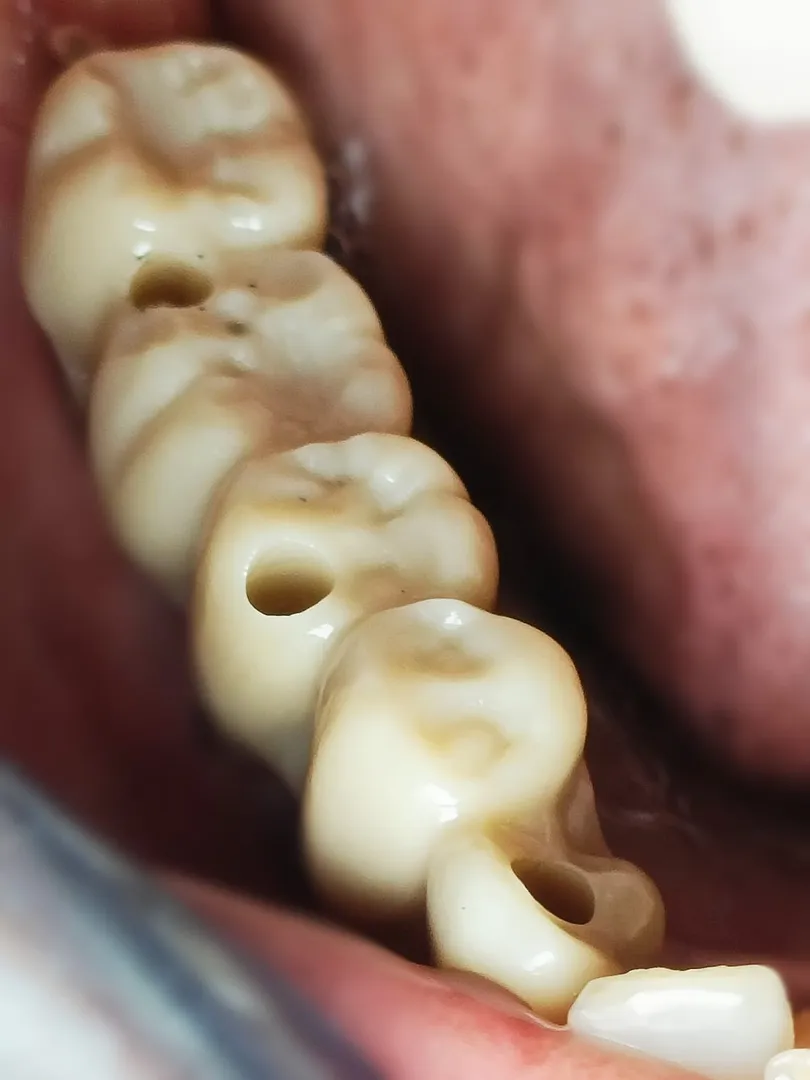 5 teeth on 3 Implants in just 3 appointments, Impl...