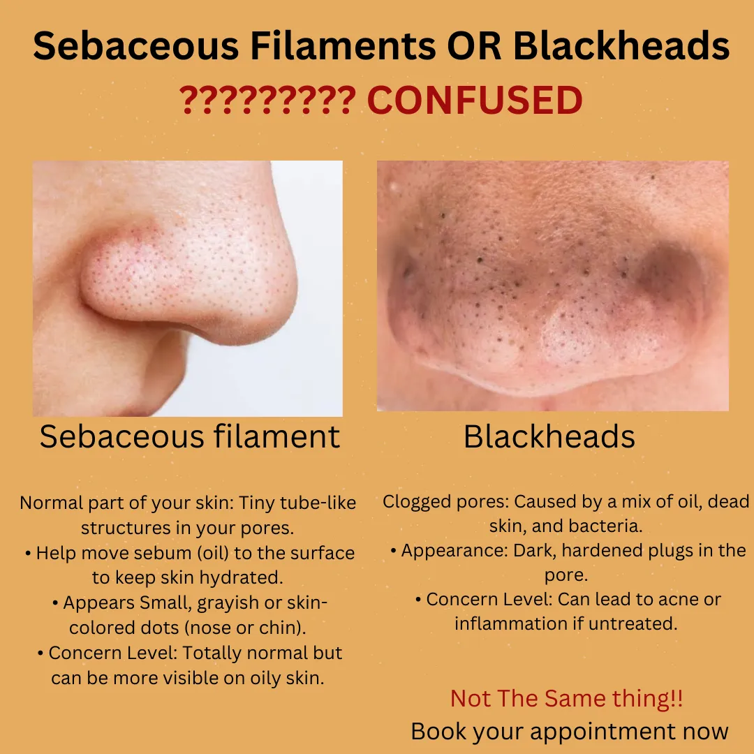 🌟 Sebaceous Filaments vs. Blackheads: What’s the D...