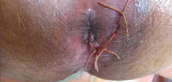 Fistula-in-Ano: An Ayurvedic Perspective Authored ...