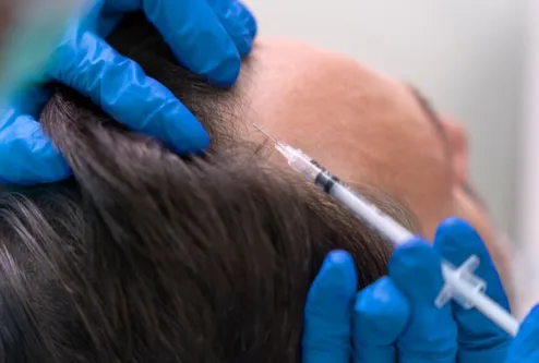 Best PRP Treatment for Hair Loss in Pune Platelet-...