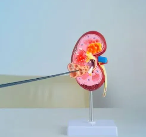 Best Kidney Stone Surgeon in Thane When kidney sto...