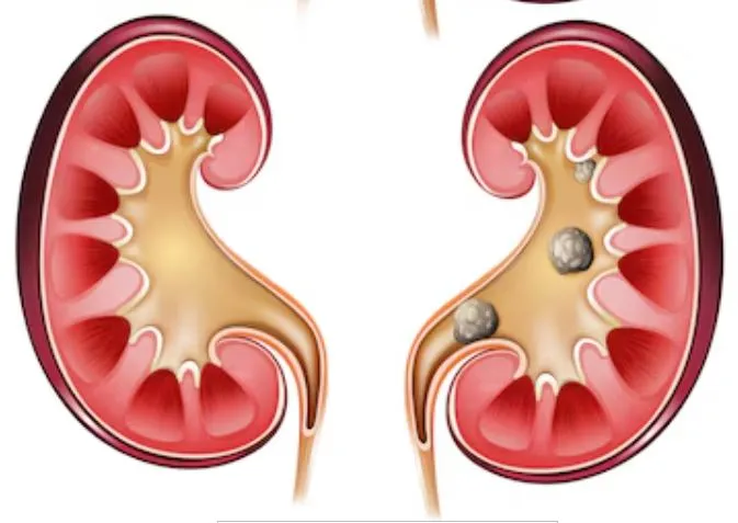 Kidney Stone Removal Treatment in Thane At Dr. Viv...