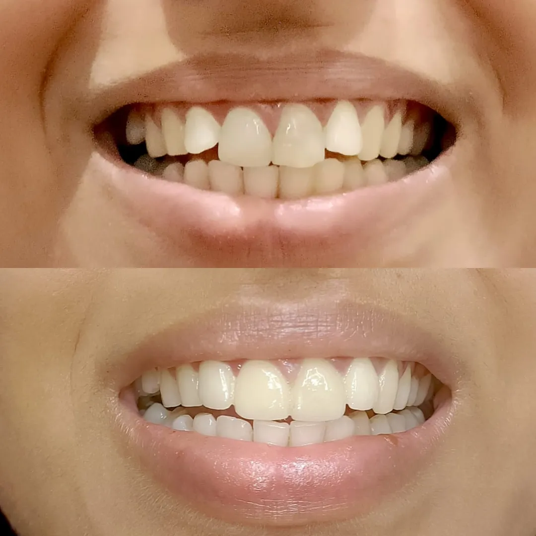 Best Smile correction option is to do ceramic vene...