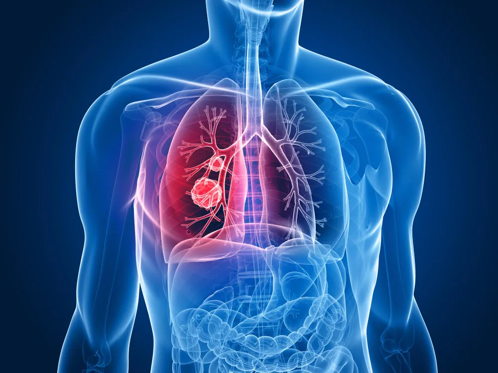 Thoracic Surgery in Nagpur: Expert Care for Chest ...