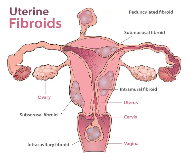 Fibroid Treatment in Mumbai: Expert Care for Uteri...