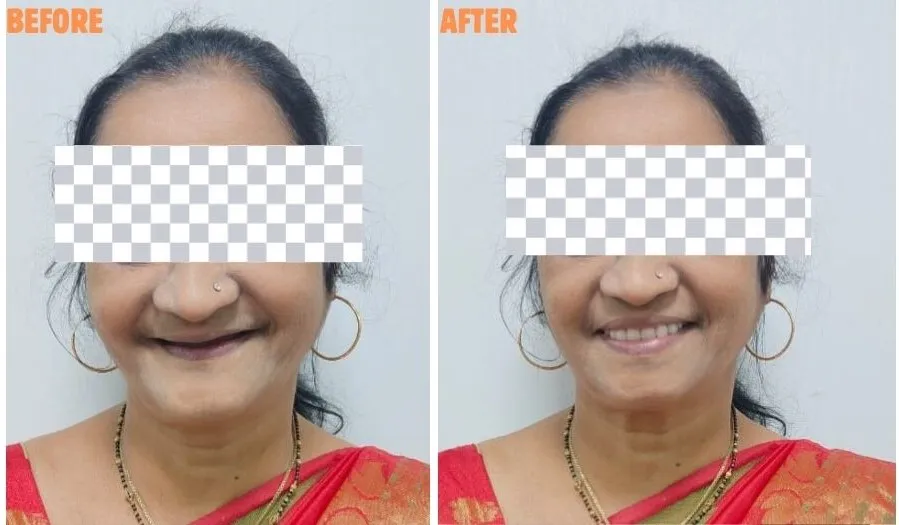 Meet Mrs. Vasanti Patil, a denture wearer since 5 ...