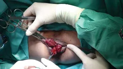 The Milligan-Morgan Technique of Hemorrhoidectomy:...
