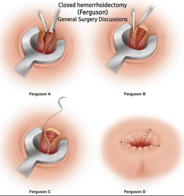 What is Hemorrhoidectomy (Closed Ferguson Techniqu...