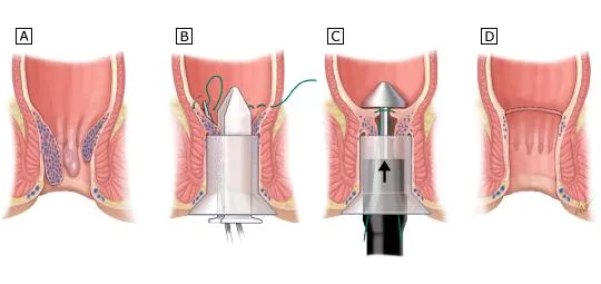 Stapled Hemorrhoidopexy (Procedure for Prolapse an...