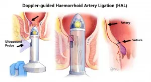 Doppler-Guided Hemorrhoidal Artery Ligation (DG-HA...