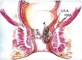 Transanal Hemorrhoidal Dearterialization (THD) A M...