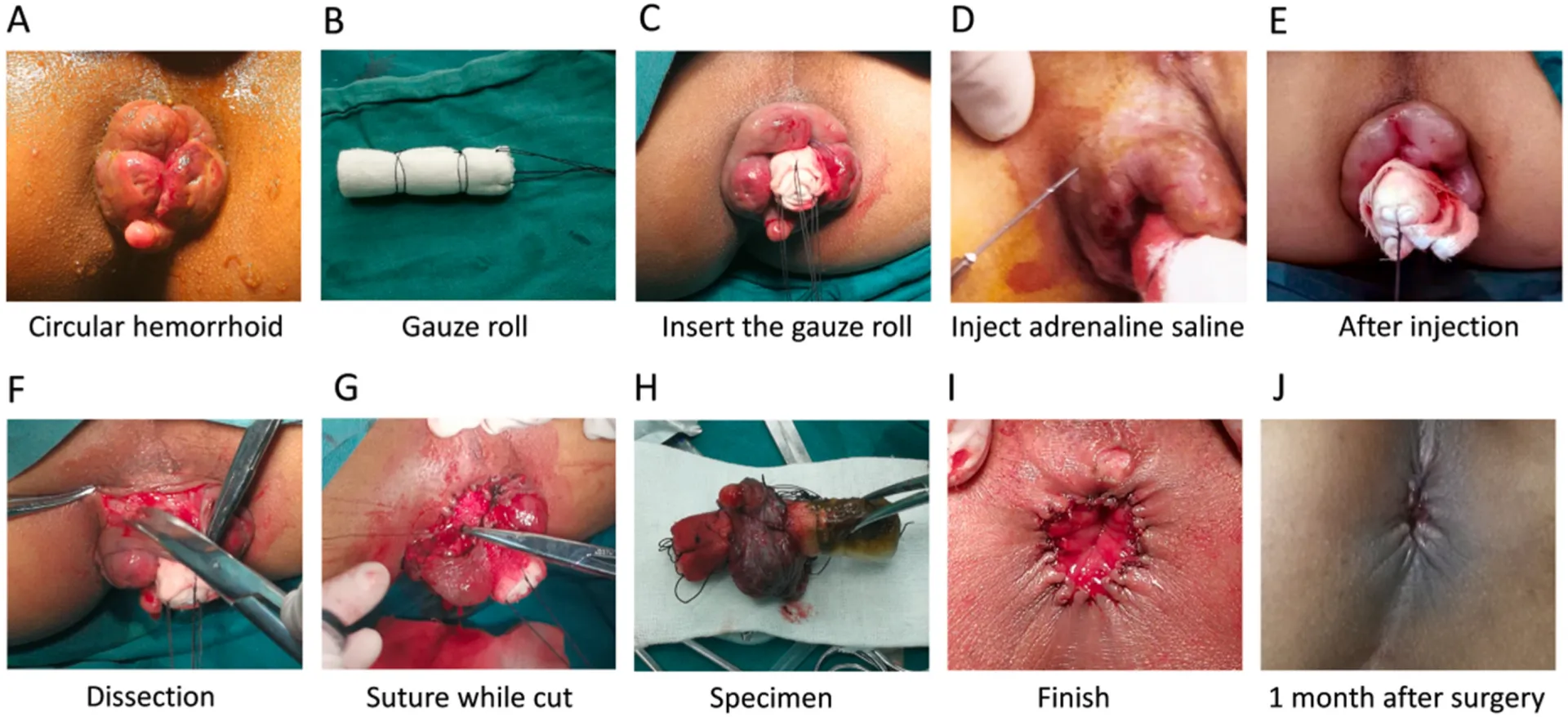 Whitehead's Hemorrhoidectomy: Traditional Surgical...