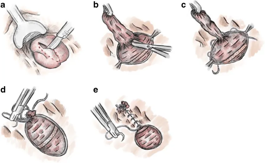 Submucosal Hemorrhoidectomy: A Less Invasive Optio...