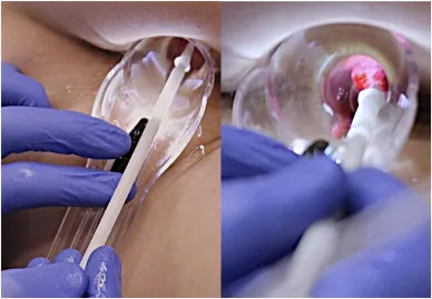 Sclerotherapy for Hemorrhoids: A Minimally Invasiv...