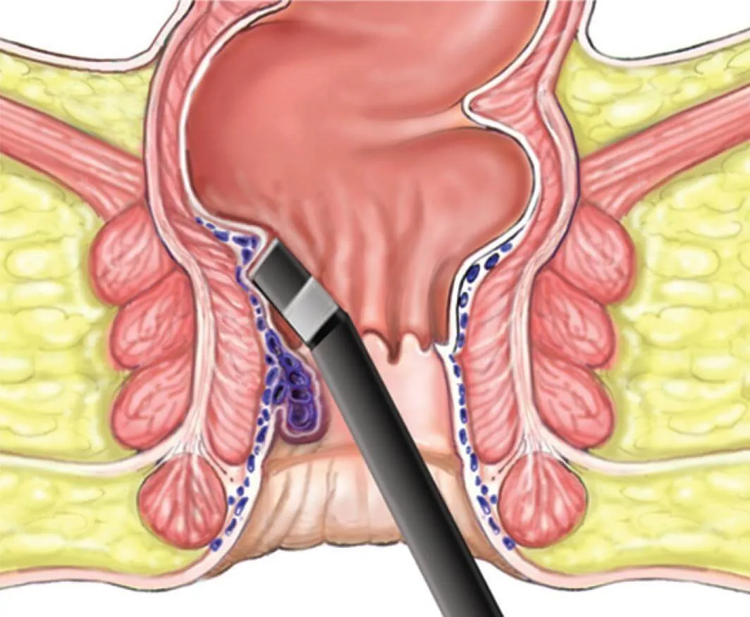 Infrared Coagulation (IRC) for Hemorrhoids: A Non-...