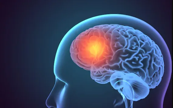 Brain Stroke Treatment in Pune - Immediate Care fo...
