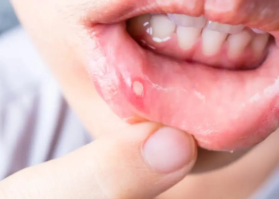 "Ulcer Are Small, But the Pain is Real" -
Let's Fi...