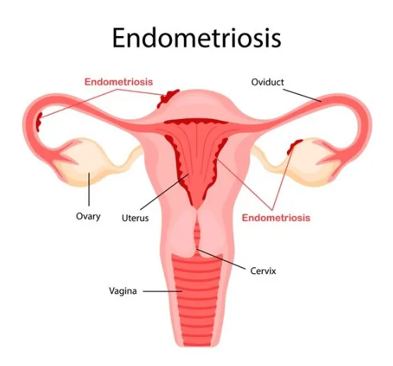 Endometriosis Treatment in Mumbai: Advanced Care f...