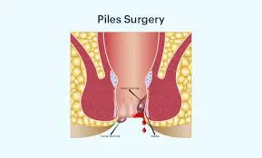 Best Piles Doctor in Pune | Best Laser Piles Docto...
