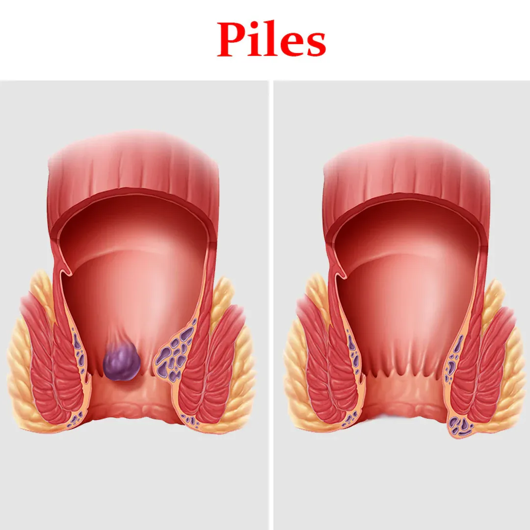 Types of Piles
Hemorrhoids, commonly known as pile...