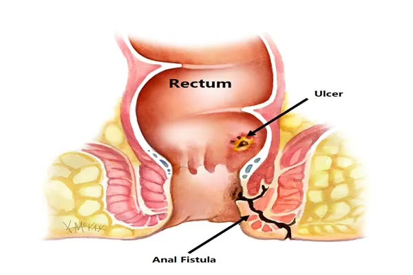 Fistula Treatment in Pune !
Pain and Discomfort
...