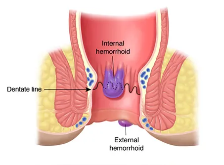 Finding Piles Doctor in Pune ? Piles Specialist in...