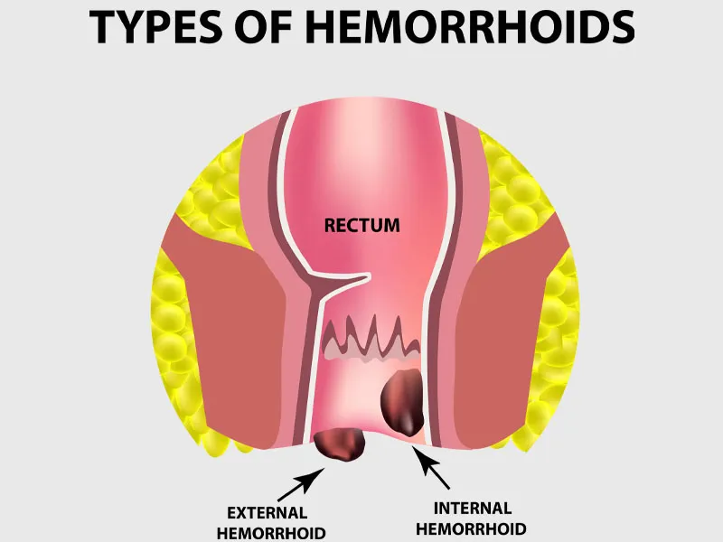Symptoms of Piles
The symptoms of piles can vary ...