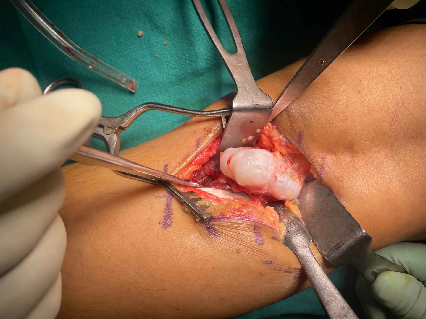Sucessful surgical excision of bony swelling from ...