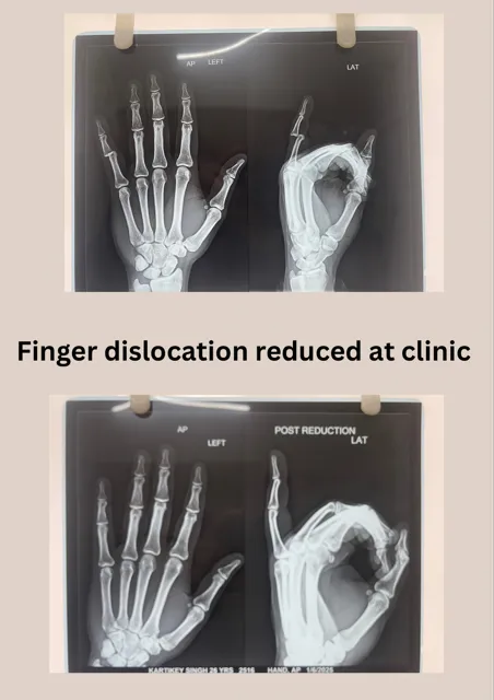 Finger dislocation reduced at clinic without anest...
