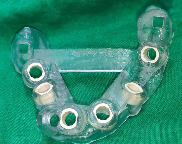 3D printed Surgical Guide is like a stencil to get...