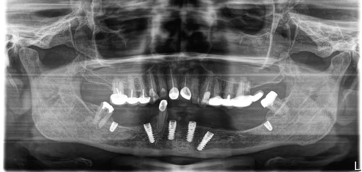 Look at the precise placement of implants in minim...
