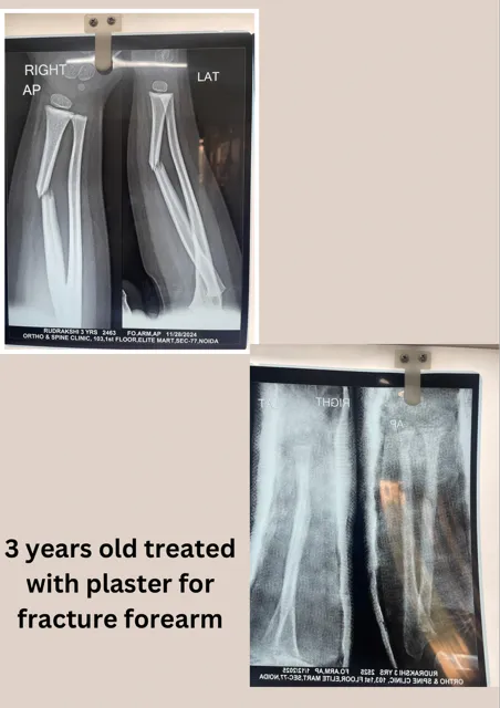 3 Years old child treated successfully by plaster ...