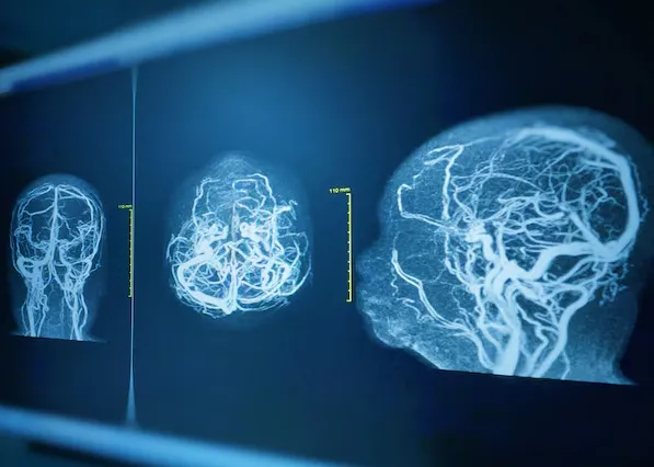 Brain Aneurysm Repair in Pune - Safe and Effective...