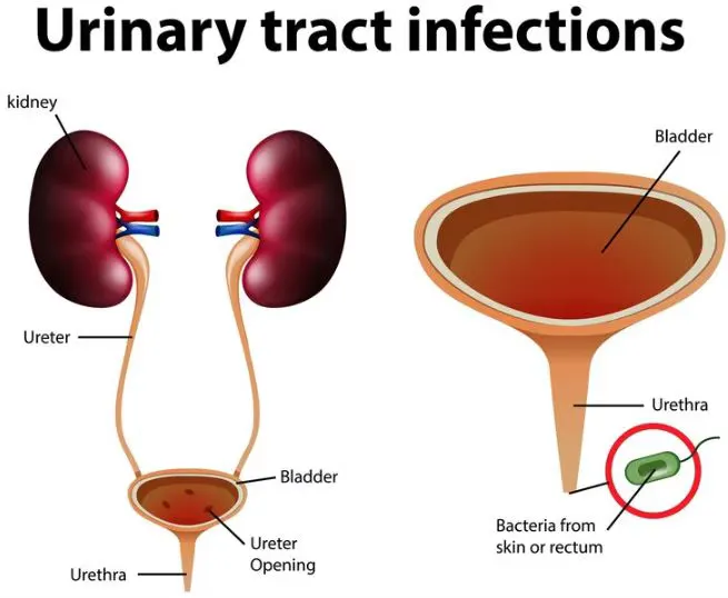 Urinary Infection Treatment in Thane: Fast Relief ...