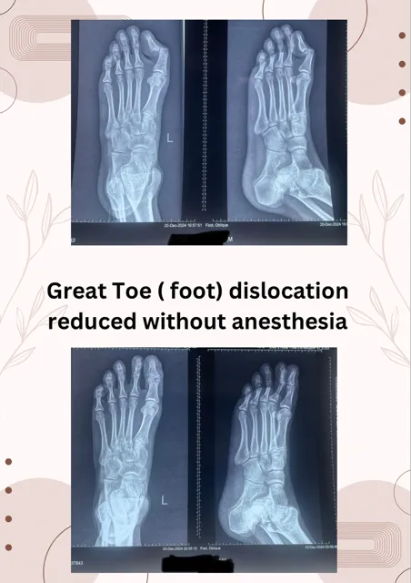 Great Toe (Foot) dislocation reduced without anest...