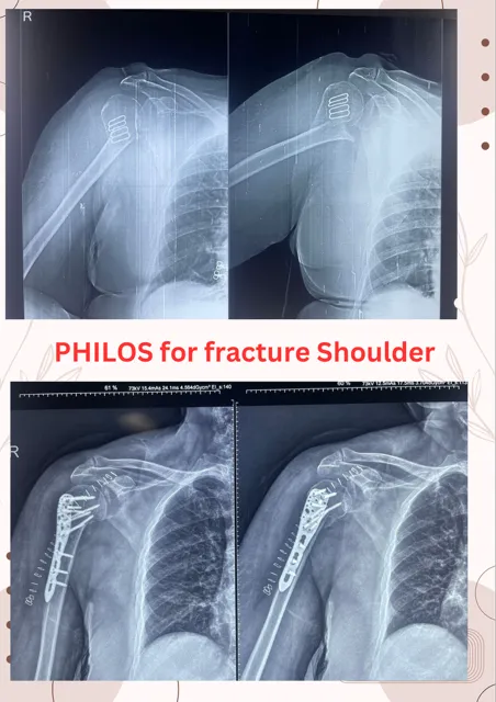 PHILOS (ORIF with proximal humerus locking plate) ...