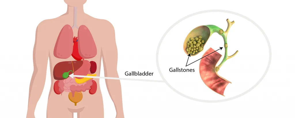 Best Gallstone Surgeon in Pune !
Are You Sufferin...