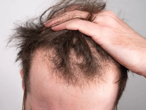 Say goodbye to hair loss with the best treatments ...